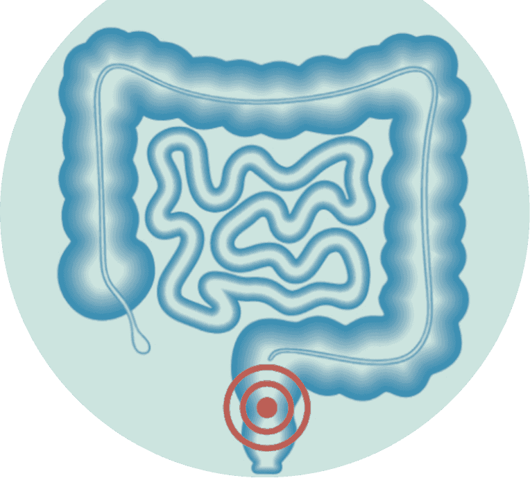 Wat is obstipatie door opioïde pijnmedicatie